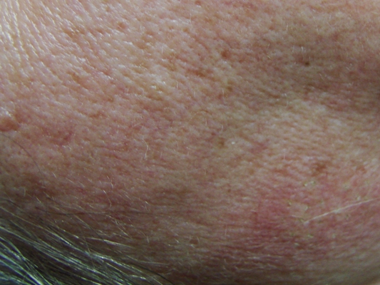 皮膚纖維瘤 (45) 