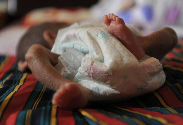 痙攣型腦癱 (60) 