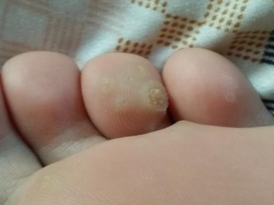腳底蹠疣早期