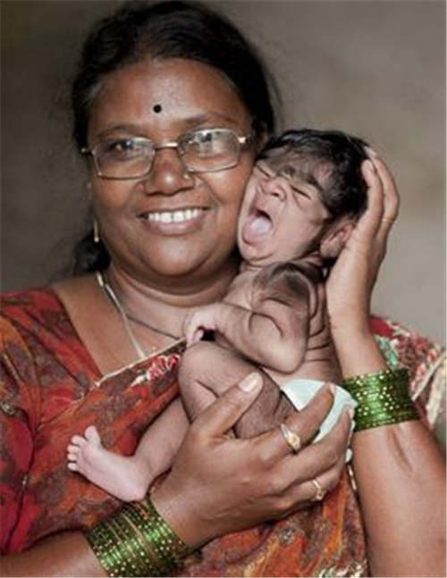 新生兒先天性多毛症