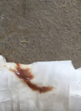 白帶帶有褐色分泌物 (6) 