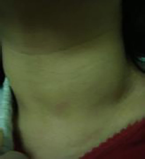 良性甲狀腺瘤早期症狀