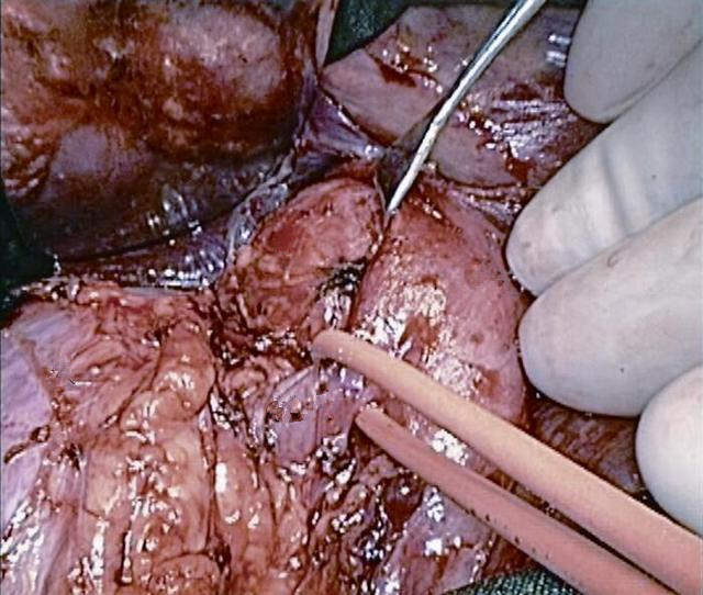 右腎上腺腫瘤部分位於靜脈後