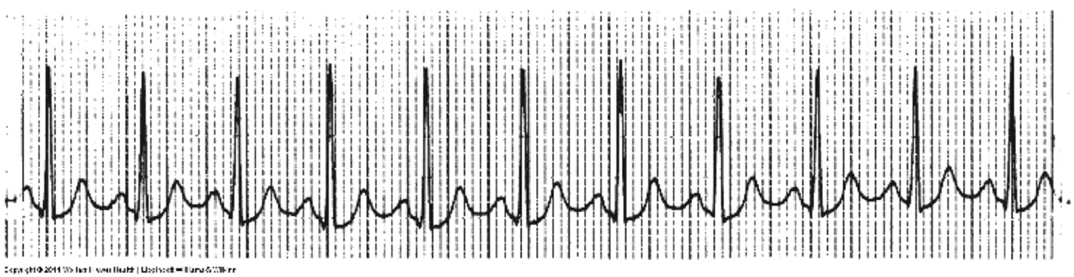 頻發房性早搏 (45) 