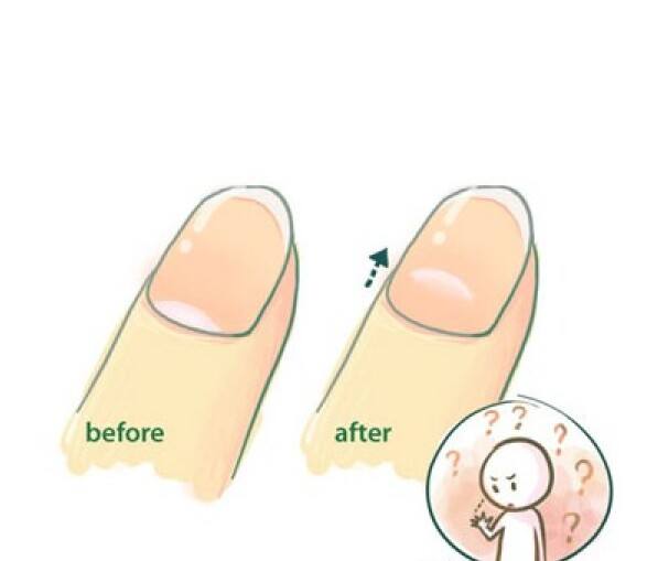 甲周炎漫畫卡通 