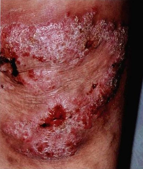 尋常狼瘡皮膚結核病