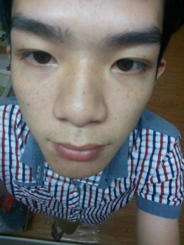 男人臉上長斑的