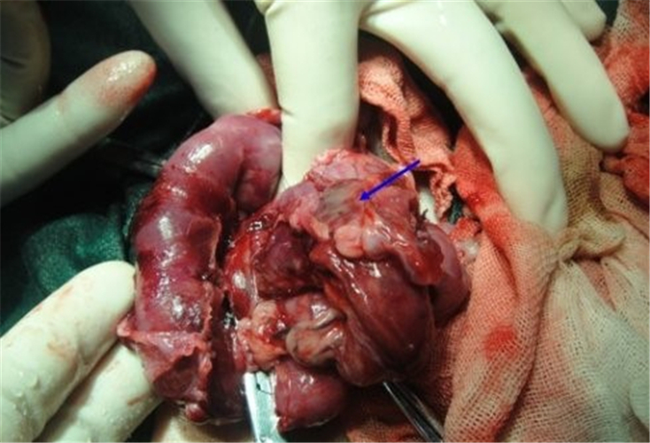 手術中的腸粘連