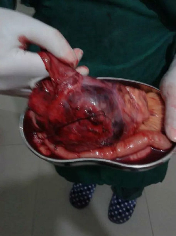 直腸腸腫瘤過程