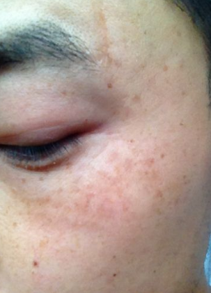 男人臉上長斑的