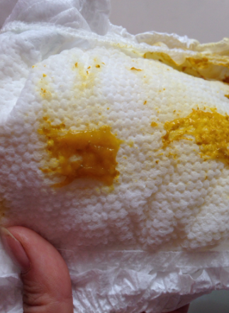 新生兒腹瀉大便