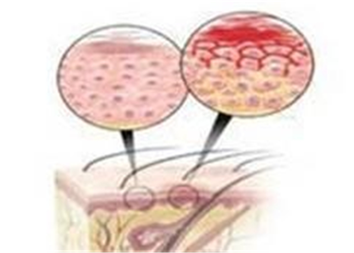 肛周溼疹解說卡通