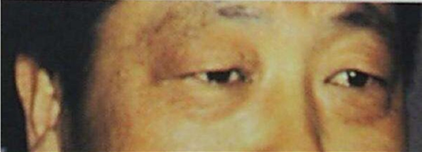 老年人甲減面部圖