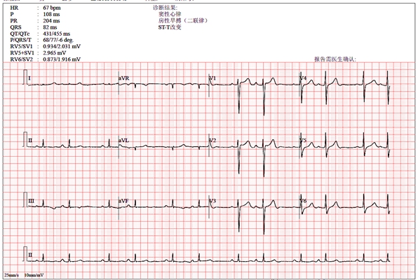 預激綜合徵心電圖 (95) 