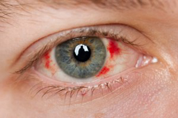 眼睛裡有血塊