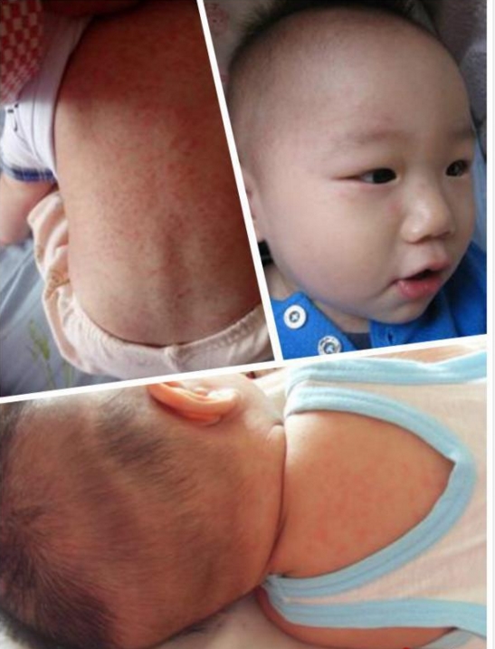 引起幼兒急疹的原因 