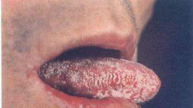 治療白色念珠菌感染 