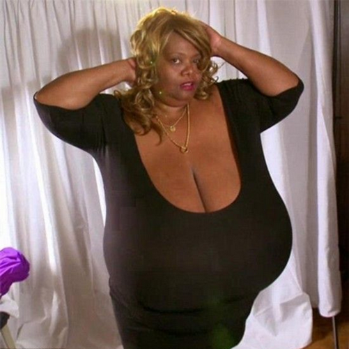 外國巨乳症患者