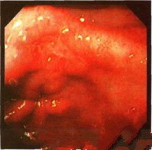 輕型淺錶慢性胃炎