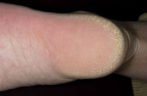 足蘚初期症狀