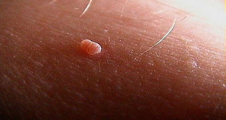 皮膚纖維瘤 (43) 