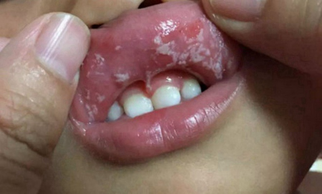 寶寶鵝口瘡 (66) 