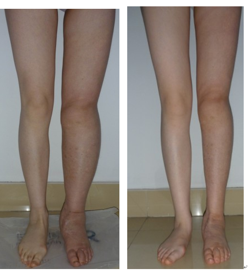 糖尿病腎病腿部水腫變化