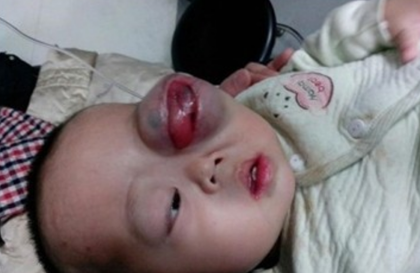 良性縱隔淋巴瘤症狀 