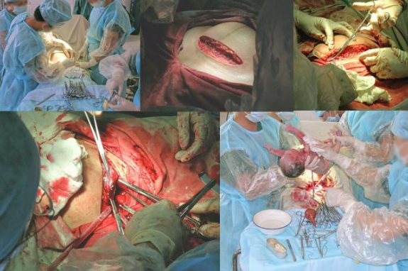 剖腹產手術 (42) 