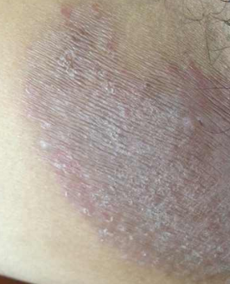 體股癬初期現象