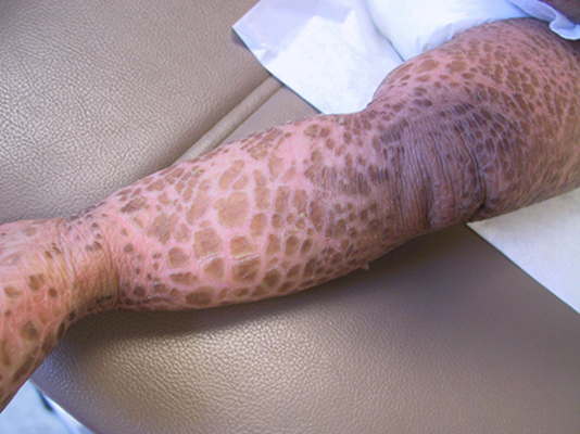 小腿皮膚像魚鱗 (50) 