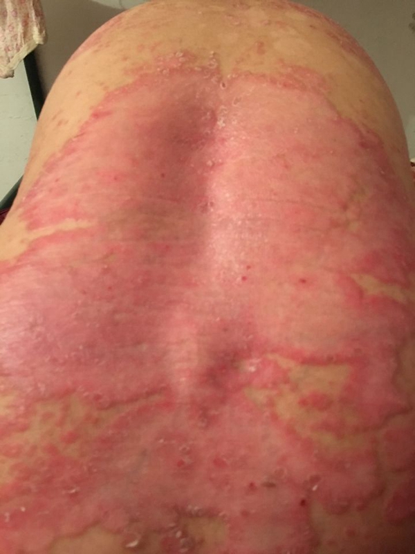 禽流感有哪些症狀