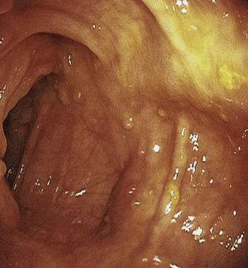 應該怎麼樣避免得慢性結腸炎的