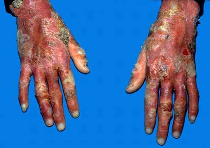 手嚴重大皰性皮膚病