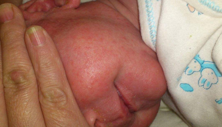 臉上皮膚過敏症狀