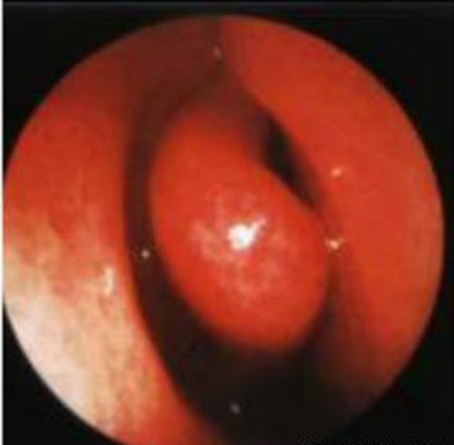 早期單純性慢性鼻炎