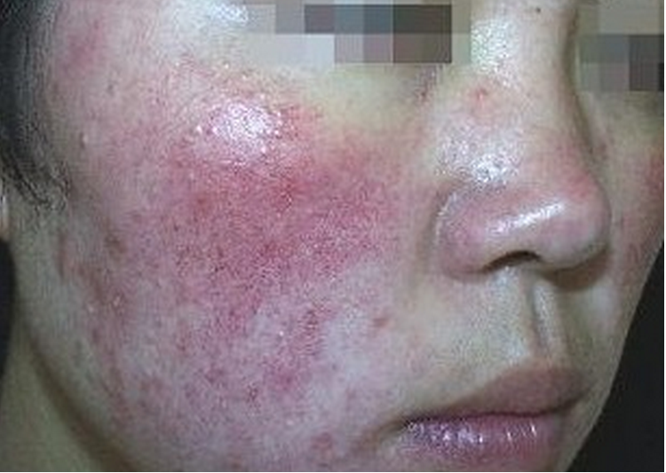 治療日光性皮炎