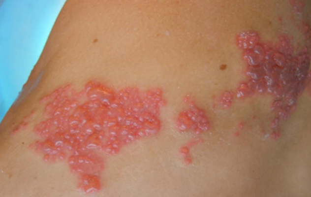 帶狀皰疹樣外觀