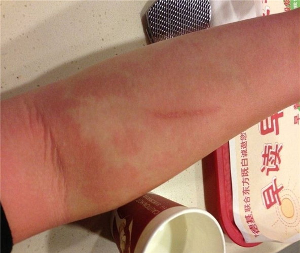 酒精中毒皮膚症狀