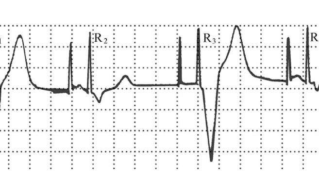 房顫心電圖特點 (42) 
