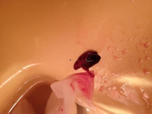 流產掉下來的孕囊