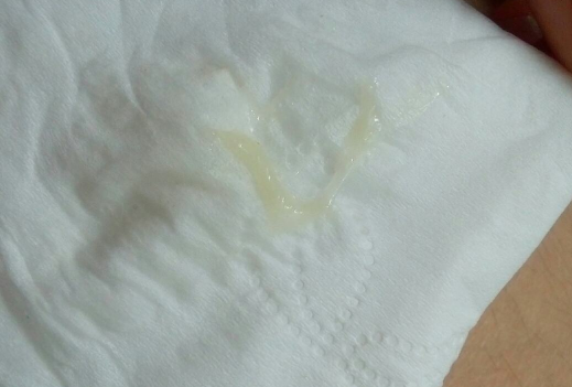 白帶帶有褐色分泌物 (5) 