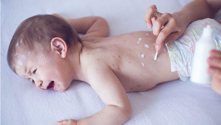 長水痘的症狀 (56) 