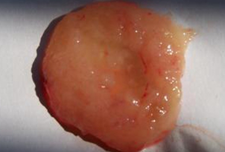 早孕藥流排出的孕囊形狀