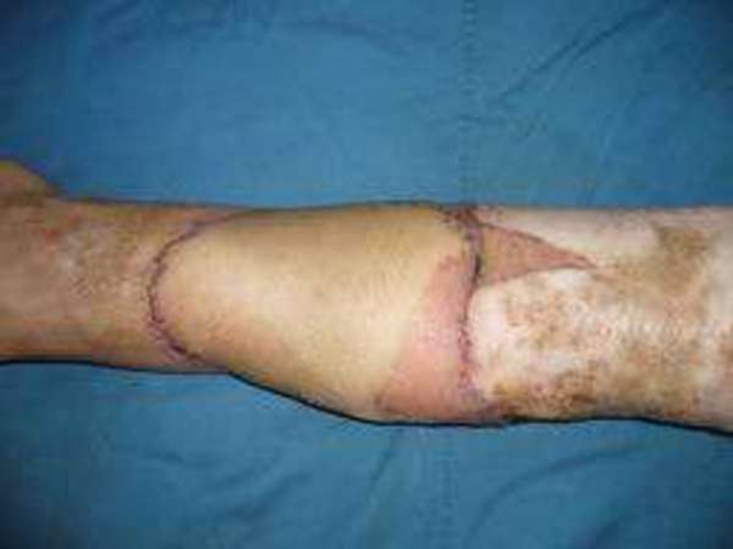 遊離皮瓣修復皮膚腫瘤