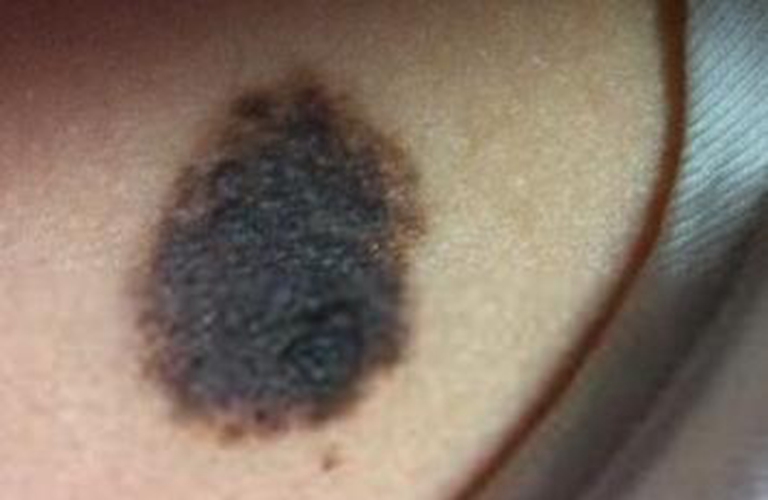 佔皮膚腫瘤死亡病例的極大局部