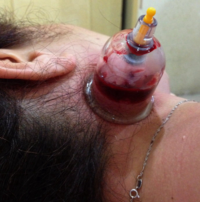 頜下淋巴結腫大