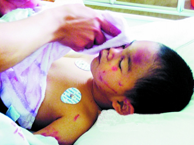 毆打致兒童腦出血