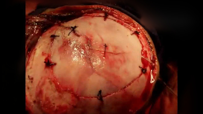 硬膜下血腫 (30) 