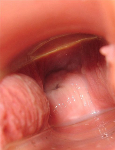 子宮肥大圖 (39) 